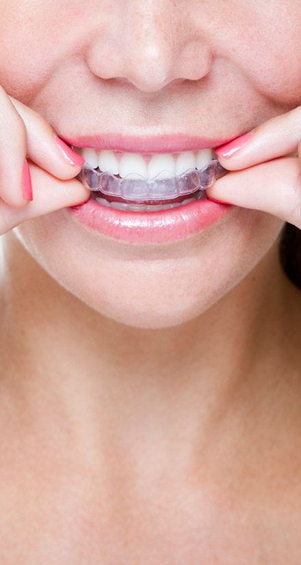 Invisalign Timberlands Dental Care in Red Deer